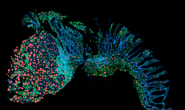 Drivers of cancer development: the inflammatory messenger oncostatin M increasingly observed in the vicinity of tumors (red), less so in healthy intestinal tissue with a normal cell structure (right). Charité | Ahmed Hegazy