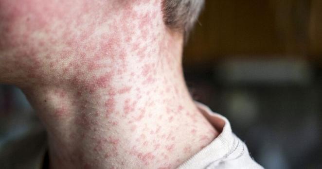 Crisis in Spain as tourist hotspots hit with disease outbreak | World | News