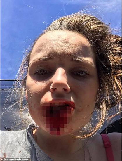 In 2017, Kayla Hayes, who was just 17 at the time, was viciously attacked in Simpsonville, South Carolina, by her abusive ex-boyfriend, Seth Aaron Fleury, then 21, because she ended their relationship. Pictured on the day of the attack