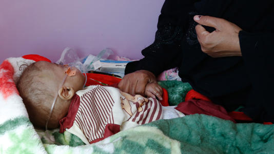 A Yemeni mother sits beside her child, who is suffering from acute malnutrition, at a medical center in Sana'a, Yemen: